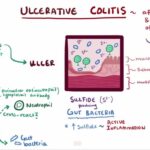 What is Ulcerative Colitis