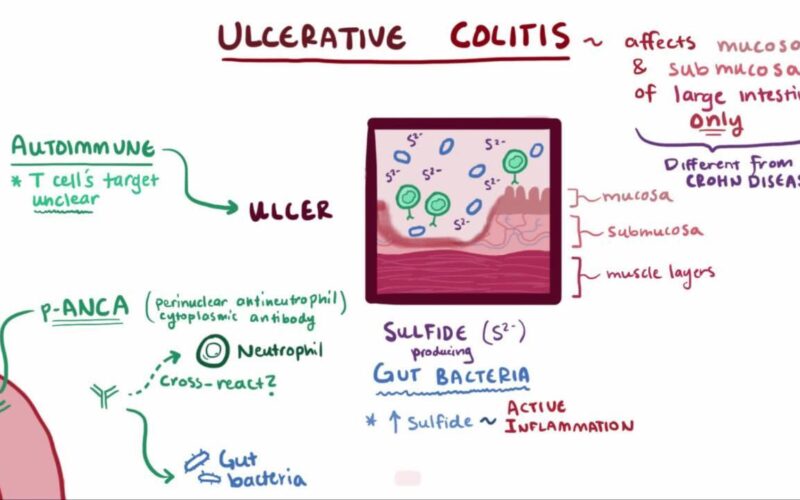 What is Ulcerative Colitis